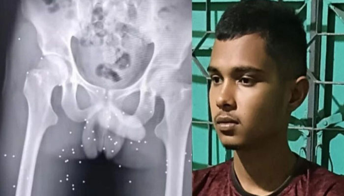 শিক্ষার্থী লিটনের শরীরে ৫০০ গুলি, উন্নত চিকিৎসার দায়িত্ব নেয়নি কেউ