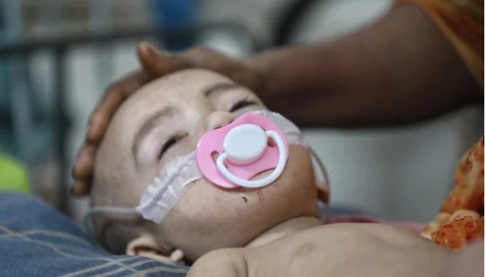 ২৪ ঘণ্টায় হাম উপসর্গে আরও ৭ জনের মৃত্যু
