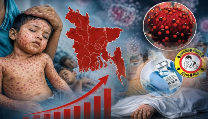 হামের উপসর্গে ২৪ ঘণ্টায় ৬ জনের মৃত্যু, আক্রান্ত ১৩৬৬
