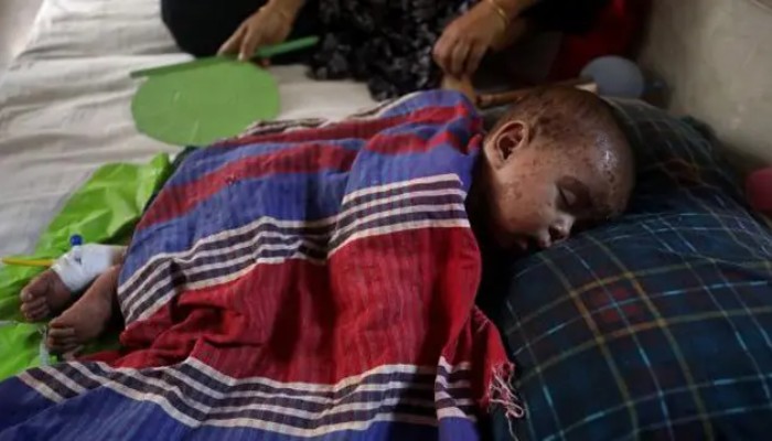হাম উপসর্গে আরও ৭ জনের মৃত্যু